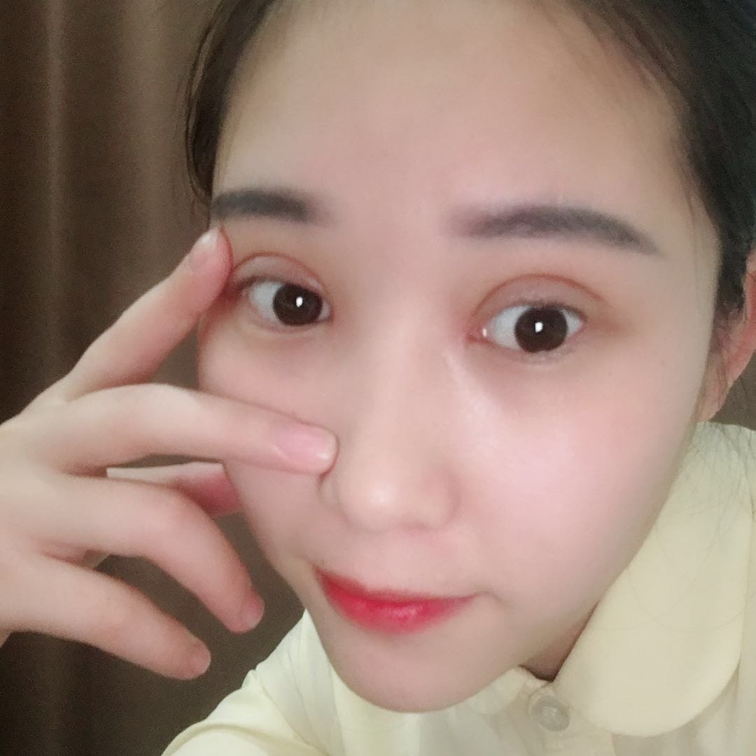 切开双眼皮第18天