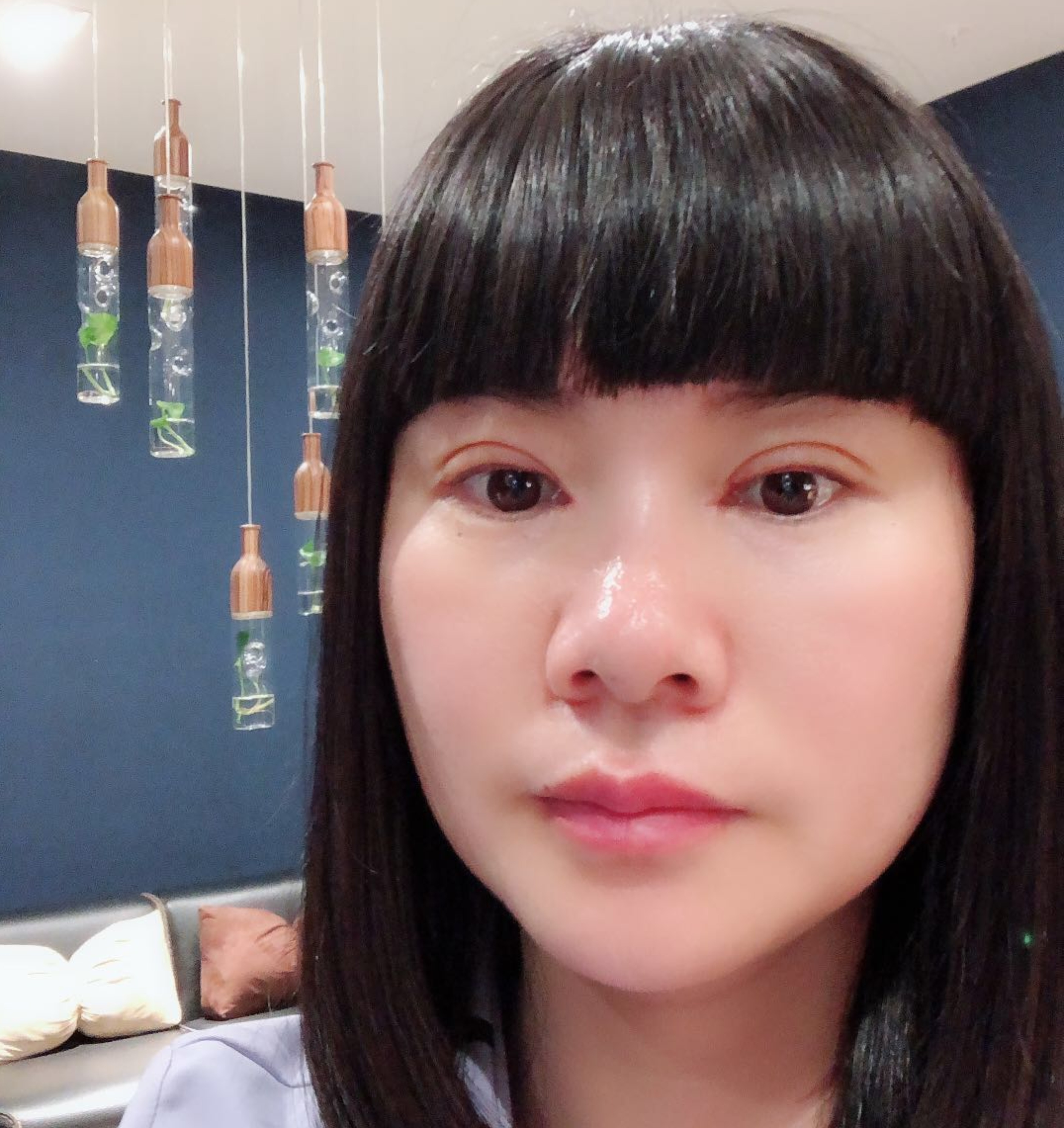 我是做的切开双眼皮和开眼角,是常规的术后七天拆线,医生看了下恢复