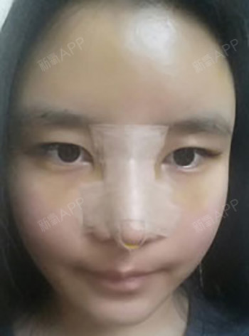 monkey233鼻综合第1天美丽日记-新氧美容整形