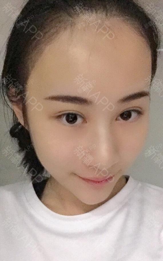 鹿7seven晗玻尿酸垫下巴第0天美丽日记-新氧美