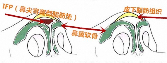 (鼻尖穹窿部脂肪垫所在的那部分区域就是鼻尖穹窿部)