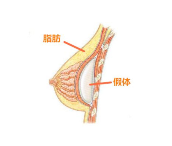 脂肪填充胸部也会有一定的局限.