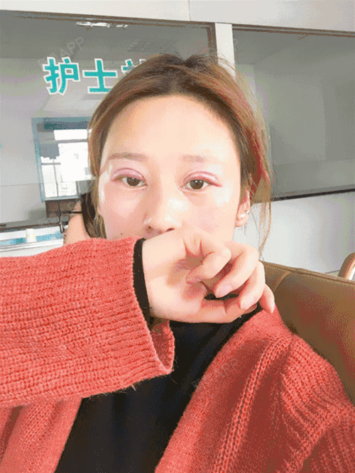新氧- 氧气3935121523501905 | 眼部 | 双眼皮 | 切开双眼皮 | 术后当