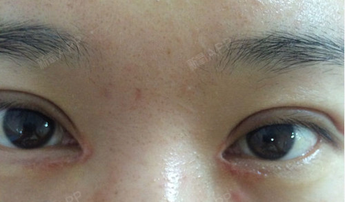 影响外科手术术后疤痕大小的一个重要因素是什么???是皮肤的张力!张力越大_圈子-新氧美容整形