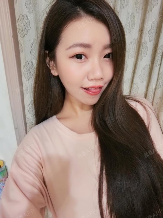 丰火控玻尿酸丰苹果肌第28天美丽日记-新氧美