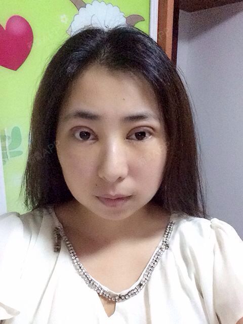 关尔一个正玻尿酸垫下巴第1天美丽日记-新氧美