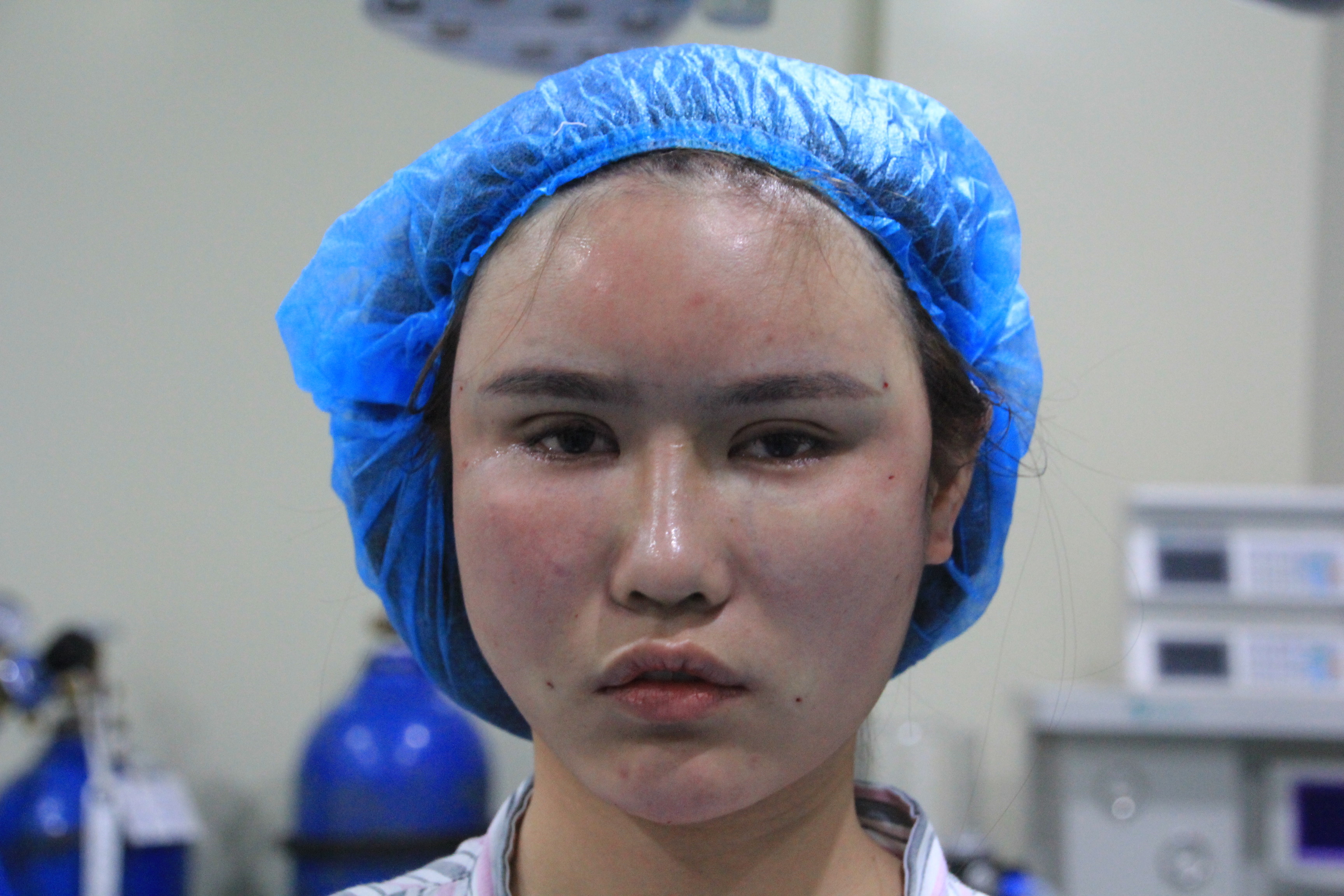 刚自体脂肪填充的苹果肌说话表情多会不会受影响?