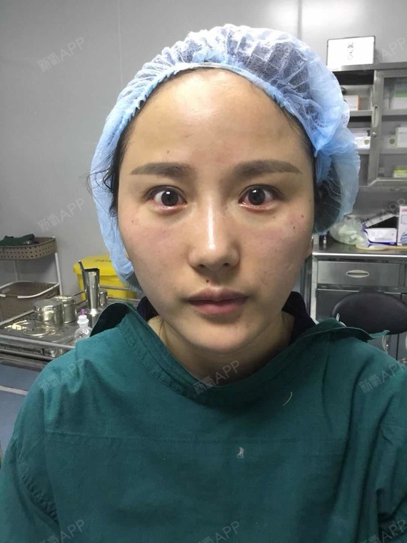 15203308465492.code.monkey自体脂肪丰泪沟