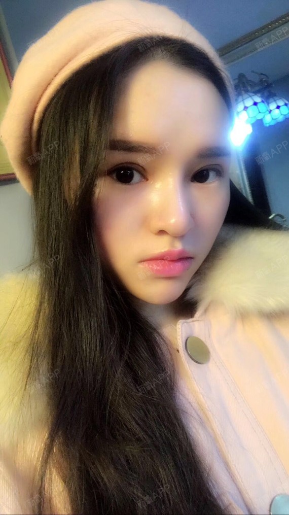 你承认吧肉毒素瘦脸第16天美丽日记-新氧美容