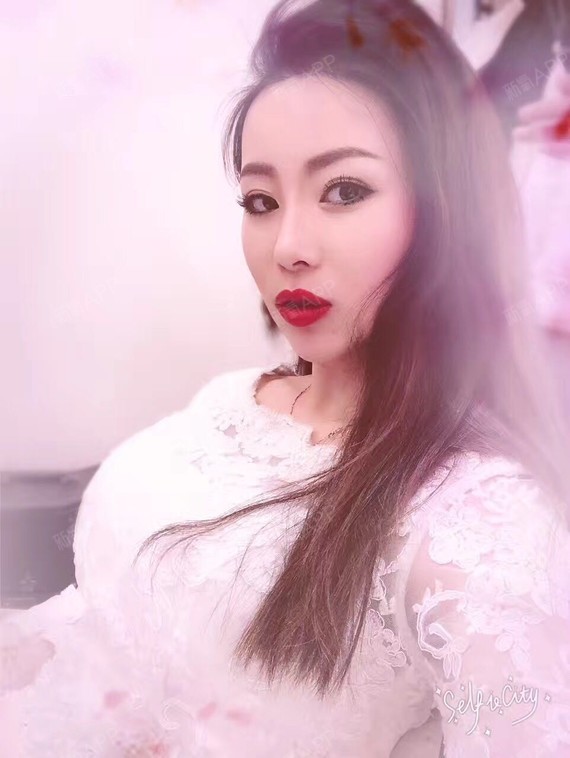 大美丽啊大美丽切开双眼皮第311天美丽日记-新