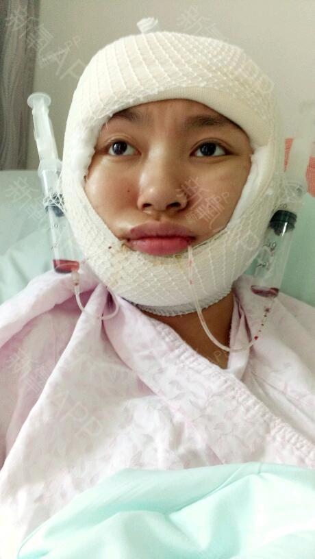 自然范er下颌角整形第1天美丽日记-新氧美容整