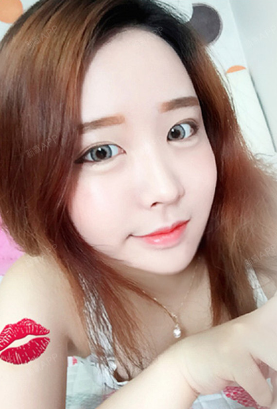 卡卡卡琼玻尿酸丰卧蚕第46天美丽日记-新氧美