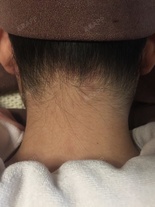 小姐姐的发际线脱毛后是不是更清爽呢?
