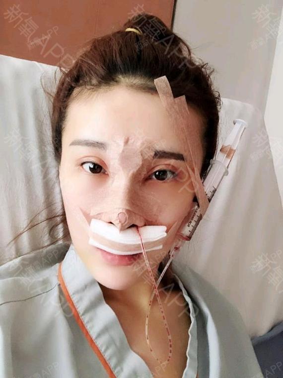 最最可爱的孩子鼻综合第1天美丽日记-新氧美容