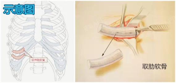 想要做肋软骨隆鼻的宝宝看过来