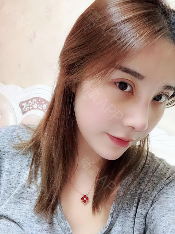 最最可爱的孩子鼻综合第7天美丽日记-新氧美容