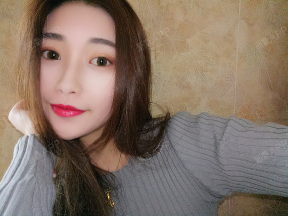 小建双硅胶隆鼻第61天美丽日记-新氧美容整形