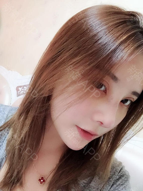 最最可爱的孩子鼻综合第7天美丽日记-新氧美容