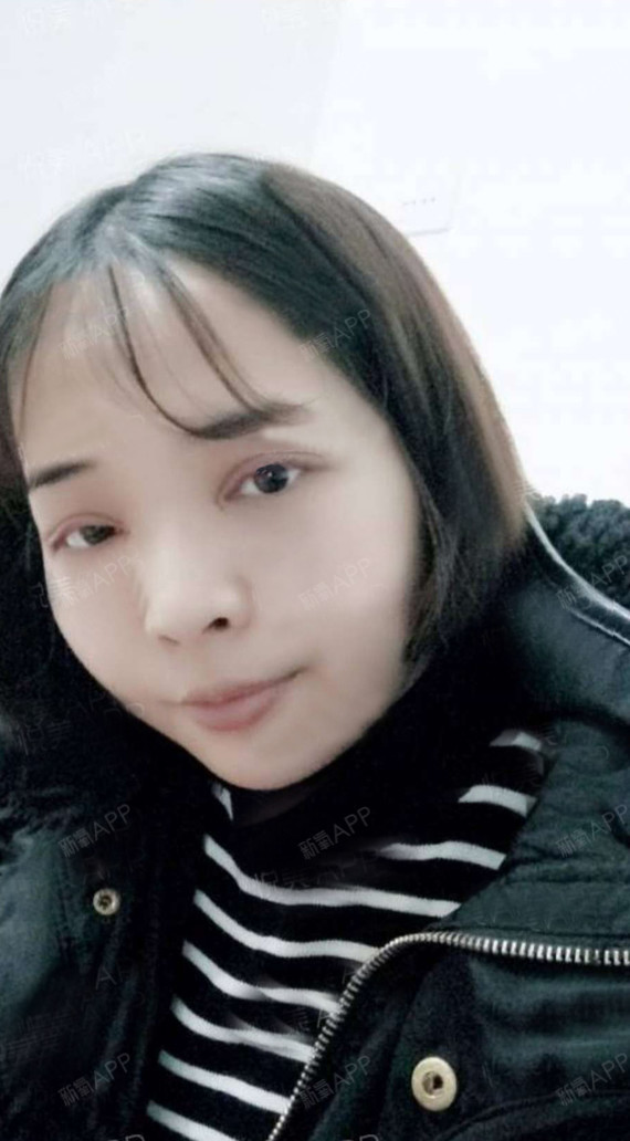 金华丽都整形:余医生切开双眼皮第1天美丽日记