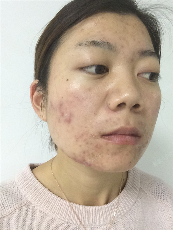 果酸焕肤