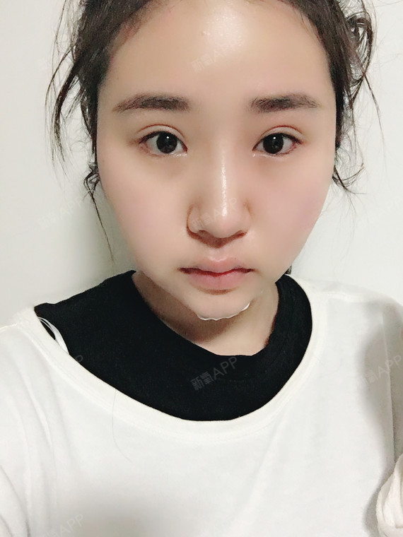 面部轮廓 | 术后当自强 | 深圳同城 | 光纤溶脂瘦脸