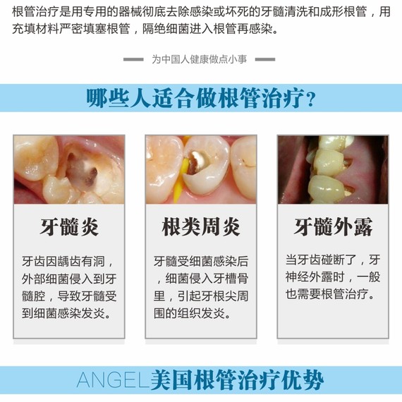 【根管治疗】后牙杀神经根管治疗