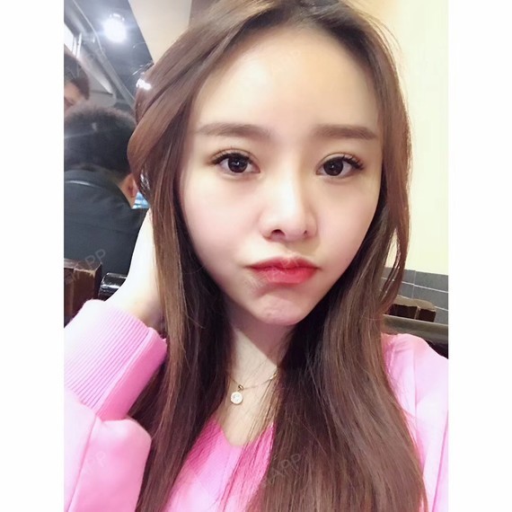 azha自体脂肪全脸填充第15天美丽日记-新氧美