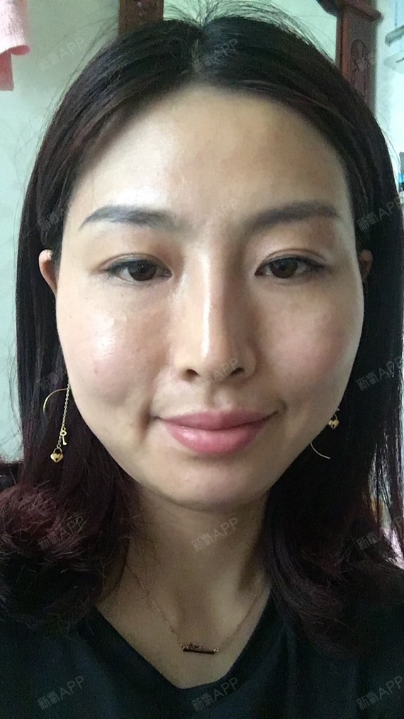 你难过什么外切去眼袋第54天美丽日记-新氧美