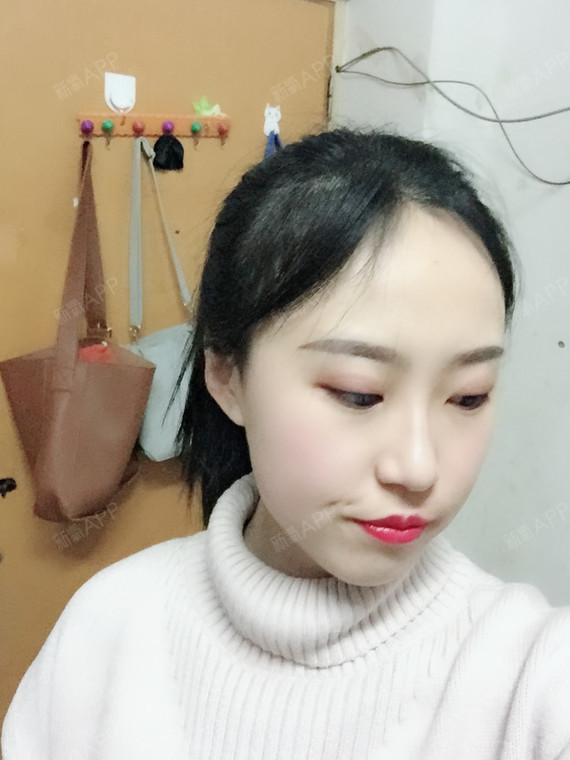 冷冰白圆金种植发际线第180天美丽日记-新氧美