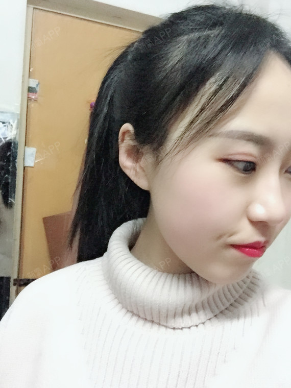 冷冰白圆金种植发际线第180天美丽日记-新氧美