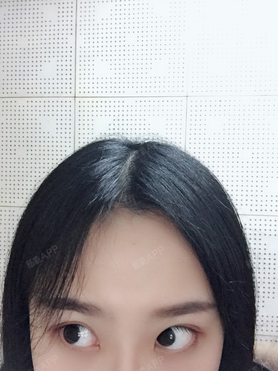 冷冰白圆金种植发际线第180天美丽日记-新氧美