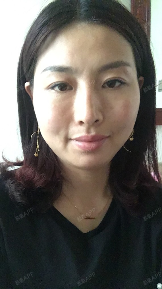 你难过什么外切去眼袋第54天美丽日记-新氧美