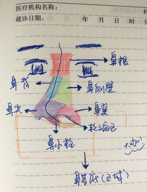 鼻背部分放一小段柳叶形假体,用以抬高鼻梁,鼻头区域分为