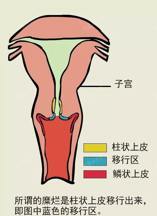 糜烂"一样的柱状上皮出现在宫颈口,这就是一种正常的生理现象.