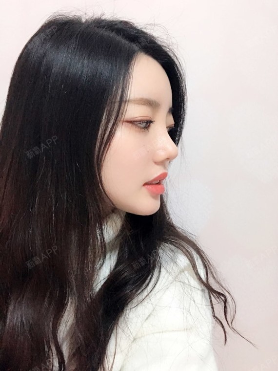 jhgfwekihrowjrpqwo宽鼻矫正第31天美丽日记-新