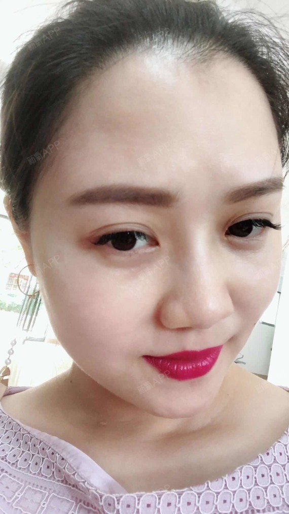 佩奇猪猪0皮秒激光第19天美丽日记-新氧美容整