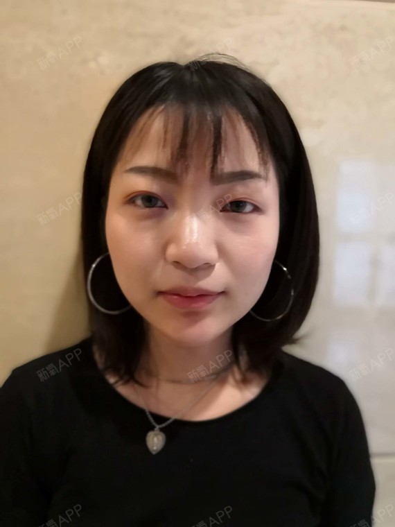 小胖纸爱吃糖玻尿酸垫下巴第1天美丽日记-新氧