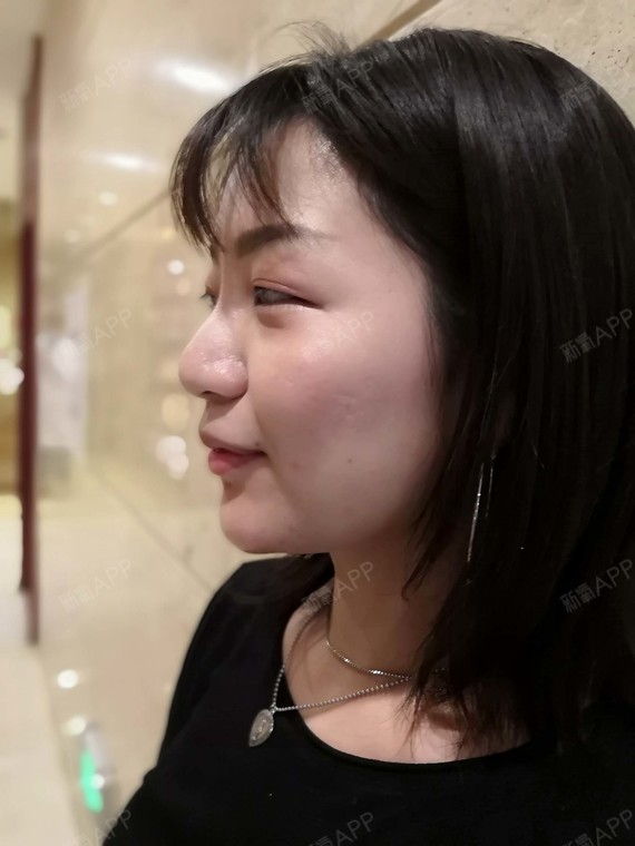 小胖纸爱吃糖玻尿酸垫下巴第1天美丽日记-新氧