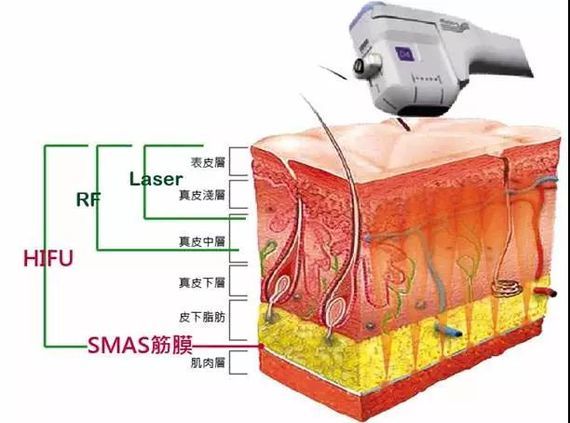 超声刀的焦点打到了皮下4.5mm的位置,就来到smas浅筋膜层上了!
