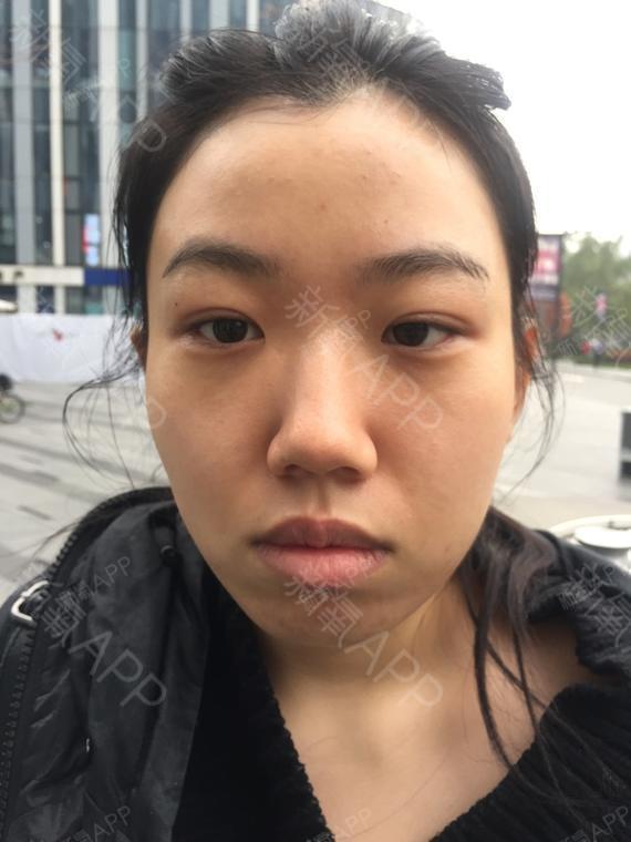 落叶一夜玻尿酸垫下巴第0天美丽日记-新氧美容