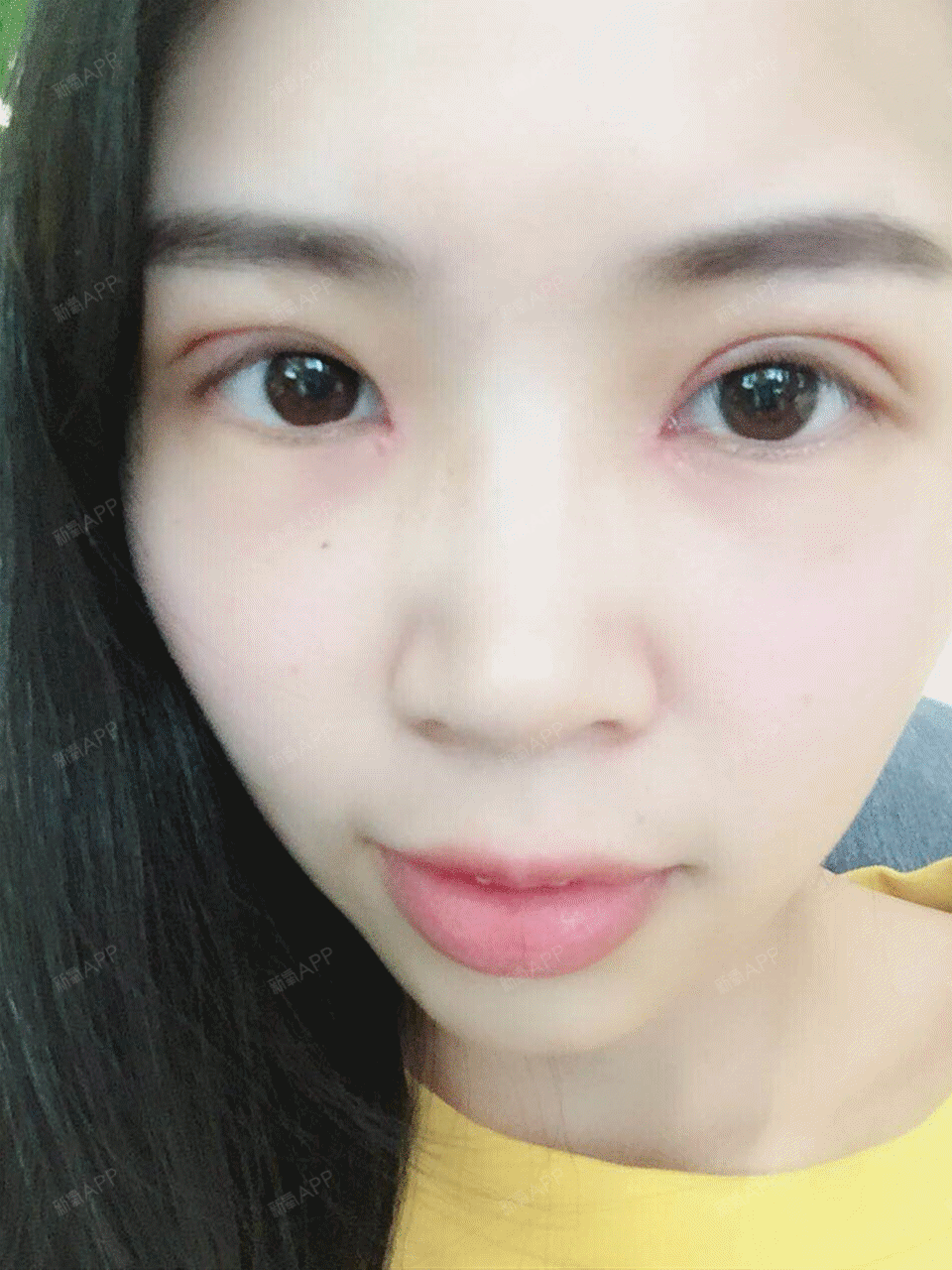 武汉亚韩整形外科医院切开双眼皮怎么样?_香菇炒肉