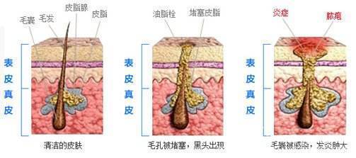 红色的痘痘里其实是含有细菌,发炎的油脂栓.