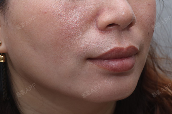 阿拉斯加犬注射祛疤第64天美丽日记-新氧美容