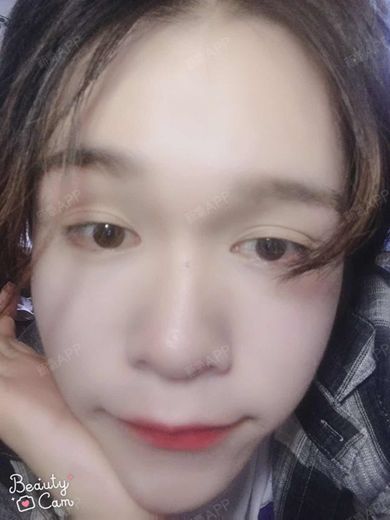 夕颜呢自体脂肪全脸填充第64天美丽日记-新氧