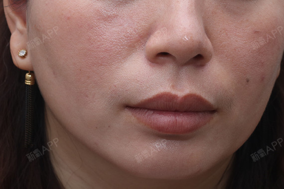 阿拉斯加犬注射祛疤第64天美丽日记-新氧美容