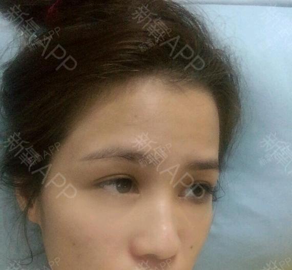 想把我唱给你听00激光去眼袋第1天美丽日记-新