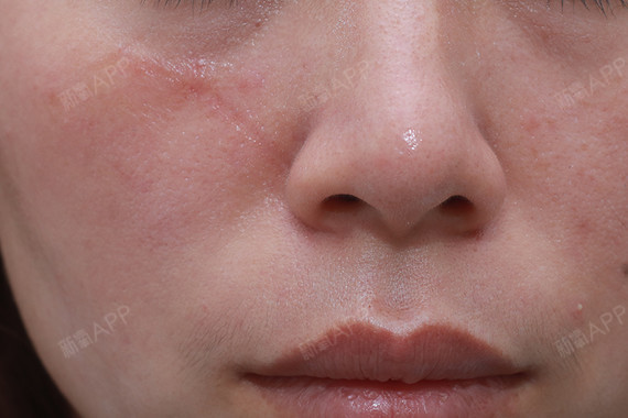 阿拉斯加犬注射祛疤第64天美丽日记-新氧美容