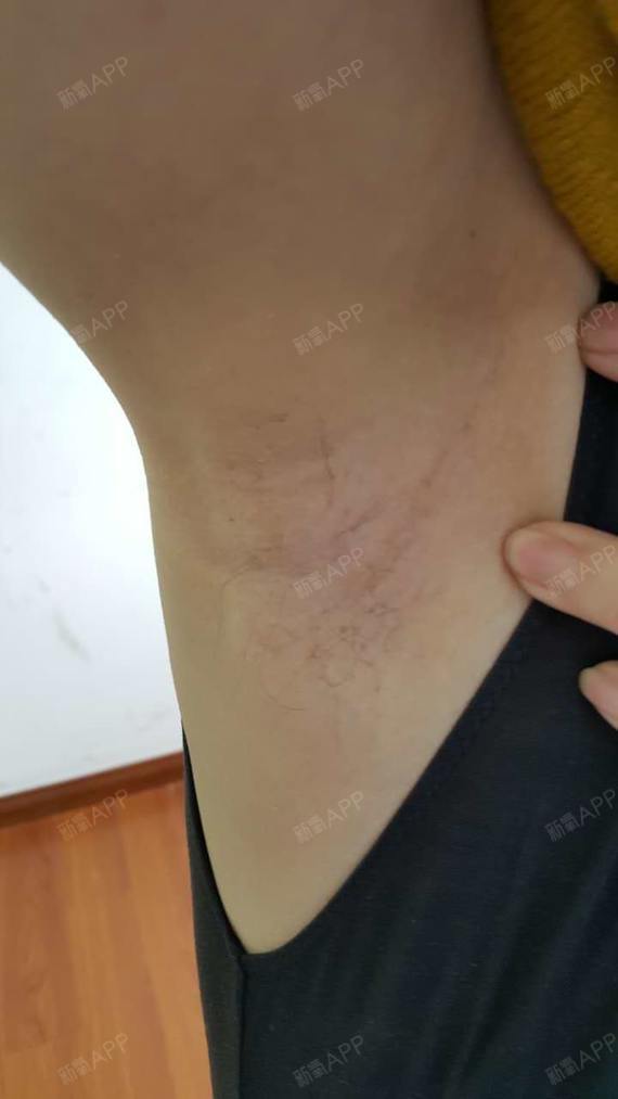 上海虹桥医院腋臭科肉毒素去狐臭第12天美丽