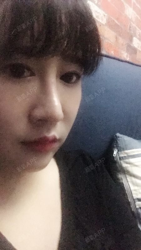 无雨雨自体脂肪全脸填充第167天美丽日记-新氧