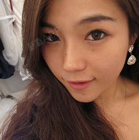 怀柔姐姐膨体隆鼻第31天美丽日记-新氧美容整形